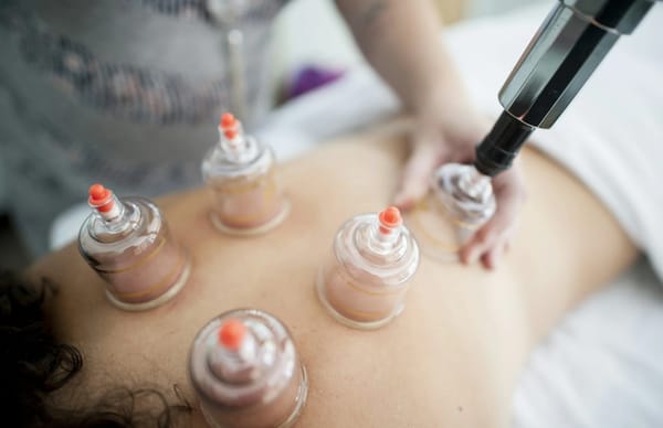 Person receiving cupping therapy with glass cups on back