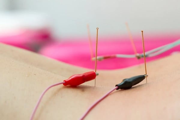 Acupuncture needles with electrical wires attached